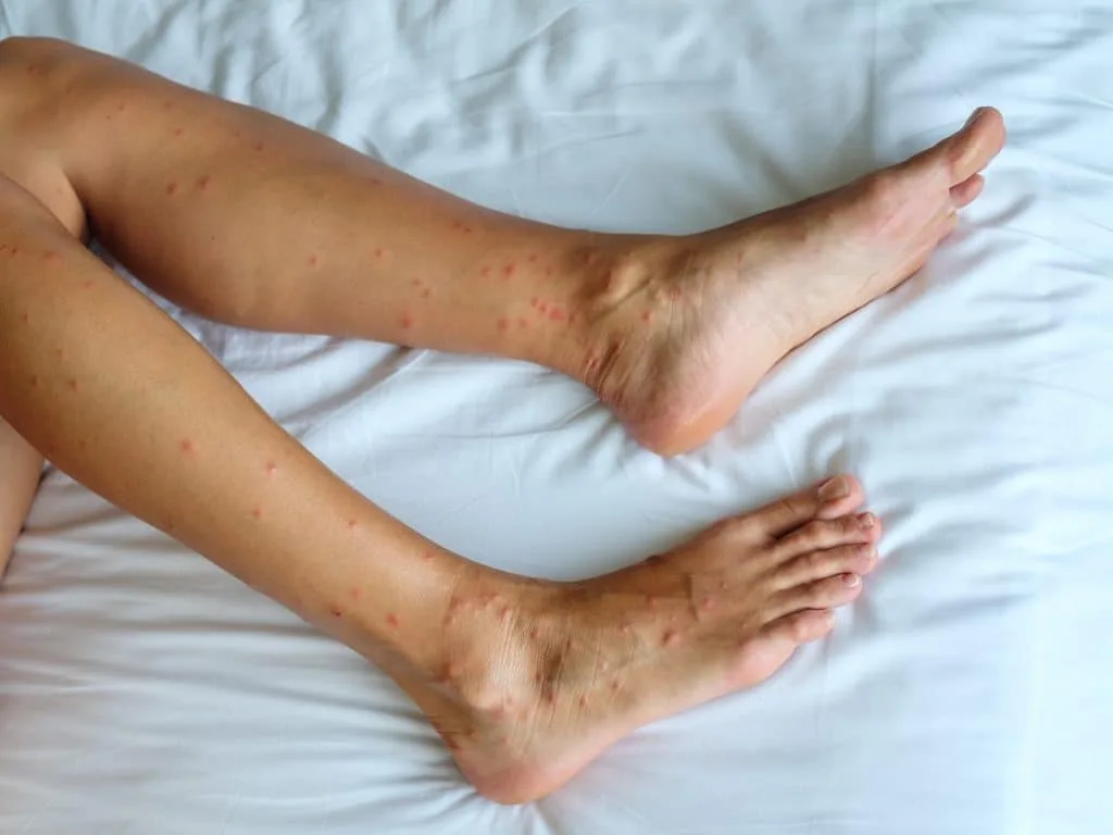 ¿Cómo Saber si Tienes Chinches en la Cama o el Colchón?
Los síntomas de una infestación de chinches de cama incluyen:

Picaduras en la piel: Normalmente en grupos o líneas rectas, especialmente en áreas expuestas como brazos, piernas y cuello.